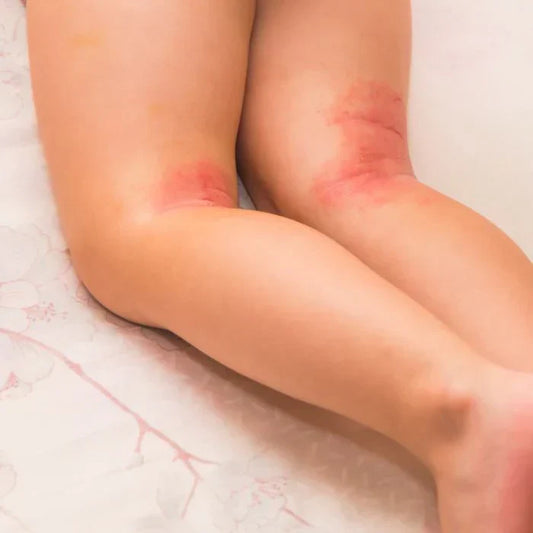 Soothing the Flame: How Emu Oil Can Help with Psoriasis and Rosacea